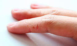 Почему кожа на пальцах рук трескается?